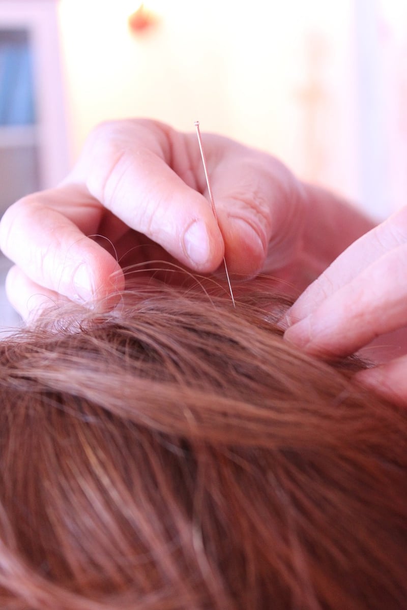 Alternative Therapy Acupuncture